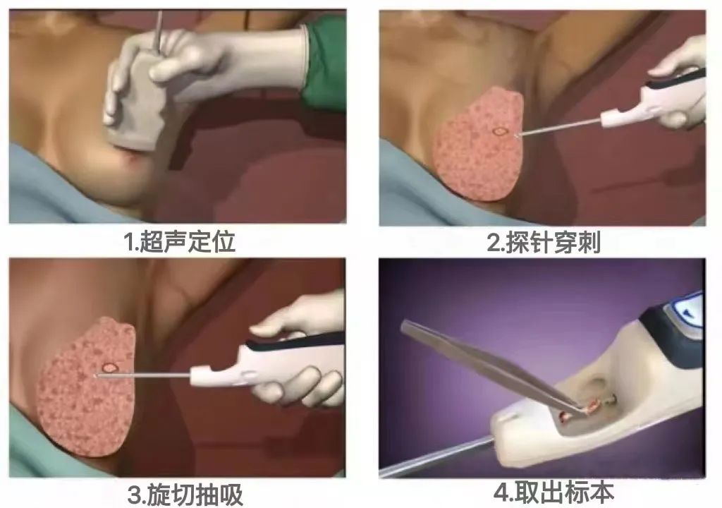 「硬实力」小切口解决大麻烦——乳腺微创旋切术让美丽不留憾