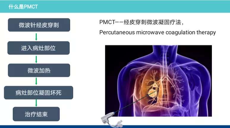2025澳门原料网站肿瘤二科完成一例恶性肿瘤肺转移高难度微波消融术